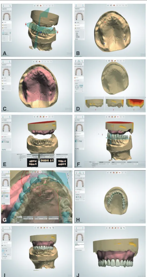 Fig. 6. CAD design process (3Shpae Dental Sysytem, 3shape, Copenhagen, Denmark). (A) Occlusal plane, (B) reference point, (C) Borderline, (D) Path of insertion,  (E) Artificial tooth selection, (F) Aligning artificial teeth, (G) Individual tooth adjustment