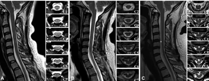 Fig. 1. Cervical MRI scans of the patient. A: At 2 months after symptom onset, a T2-weighted sagittal image shows no significant abnormality, but T2- T2-weighted axial images show suspicious focal hyperintensities (arrows) in lateral motor tracts bilateral
