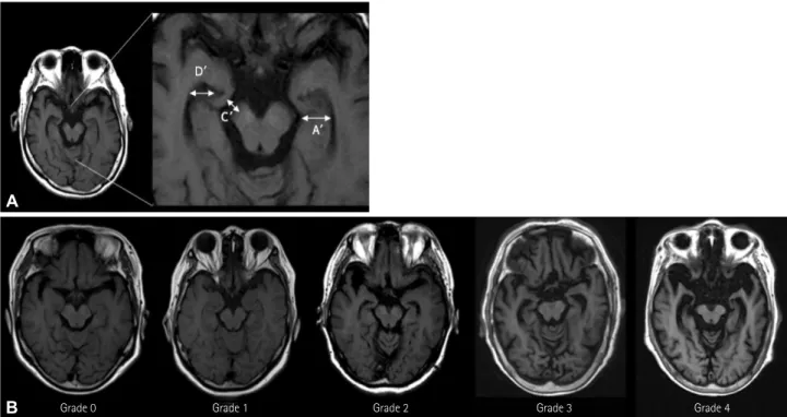 Fig. 1. A: Dimensions measured when scoring on the T1-weighted axial medial temporal-lobe atrophy VRS: width of the hippocampus (A'), width  of the perimesencephalic cistern (C'), and width of the temporal horn (D')