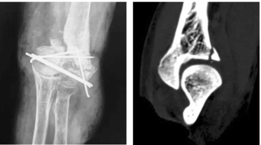 Fig. 2. Infected nonunion of the distal humerus after OR/IF