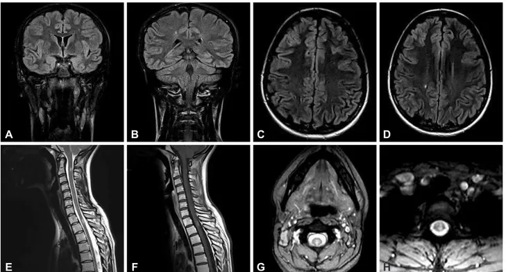 Fig. 1. Brain coronal plane FLAIR-weighted and axial plane T2-weighted scan showing hyperintense lesions in the left frontal lobe (A and C) and  in right centrum semiovale (B and D), spinal cord sagittal and axial plane T2-weighted showing hyperintense les