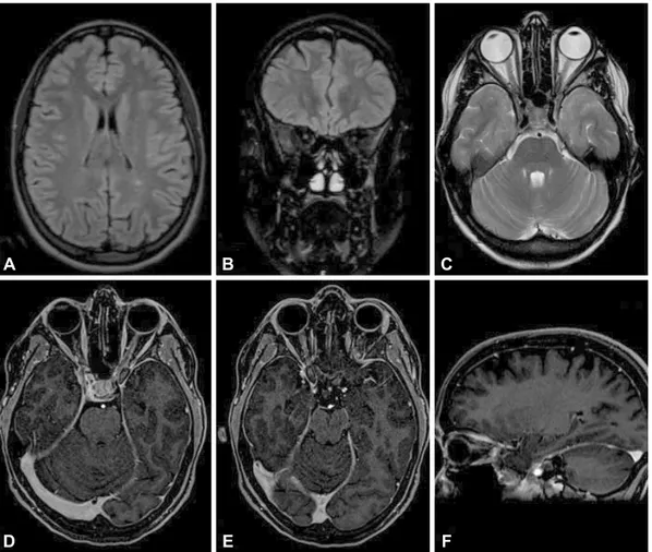 Fig. 3. Brain axial plane FLAIR-weighted scan showing hyperintensity of the left peritrigonal white matter (A) and coronal and axial plane FLAIR- FLAIR-weighted scan showing slight hyperintensity in the right optic nerve (B and C) without clear enhancement