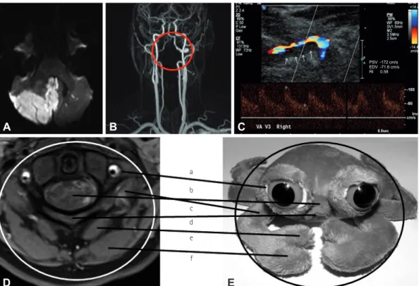 Fig. 1. Crab sign in vertebral artery dissection. Diffusion-weighted MRI shows bilateral acute ischemic cerebellar infarction that is larger on the right  side (A)