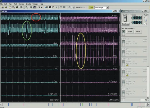 Fig. 2. Three different waveforms, two of which are artifacts. The response in the red circle is an artifact from the stimulation device