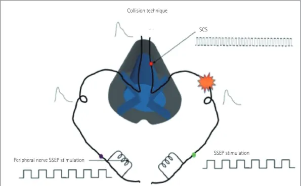 Fig. 6. Graphical representation of the basis for the SSEP collision technique. On the left side, the SSEP passes through the sensory pathways un- un-inhibited by any external SCS, thus producing a normal cortical SSEP response
