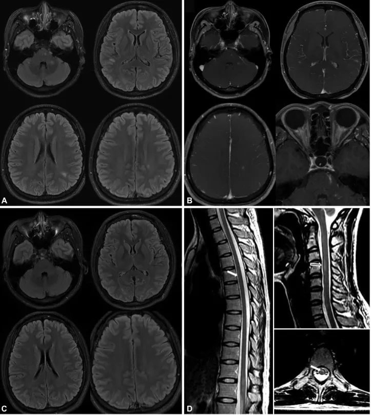 Fig. 1. MRI scans of the patient. Initial brain MRIs show multiple HSILs in the pons, middle cerebellar peduncle, subcortical and periventricular white  matter on the FLAIR imaging (A) and gadolinium-enhancement imaging (B)
