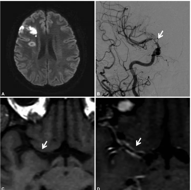 Fig. 1. A: MR diffusion-weighted image showing an acute infarct in the right middle cerebral artery and anterior cerebral artery cortical watershed  territory, and a subacute infarct in the deep watershed territory
