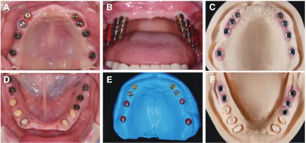 Fig. 3. Impant installation. (A) Preoperative intraoral view, (B) Operative view, (C) Postopera- Postopera-tive view, (D) PostoperaPostopera-tive panoramic view.