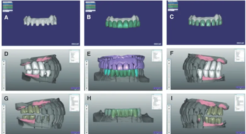 Fig. 5. Screw retained fixed interim restoration. (A) Frontal view, (B) Occlusal view.