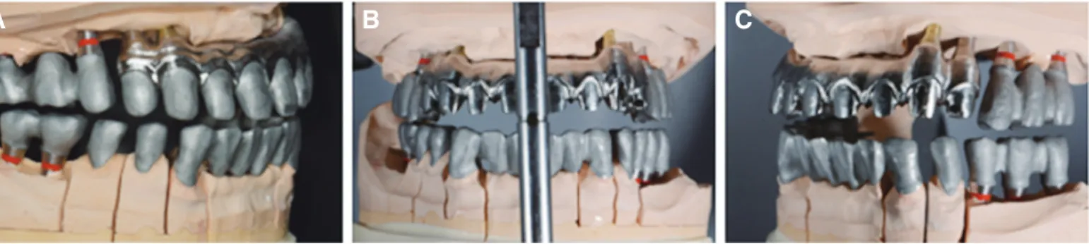 Fig. 7. Implant superstructure and coping fabricated with CAM. (A) Right view, (B) Frontal view, (C) Left view.