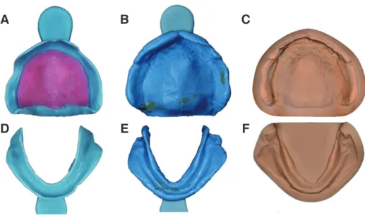 Fig. 5. Final impression taking (C, D) with individual tray (A, B) and fabrication of definitive cast (E, F).