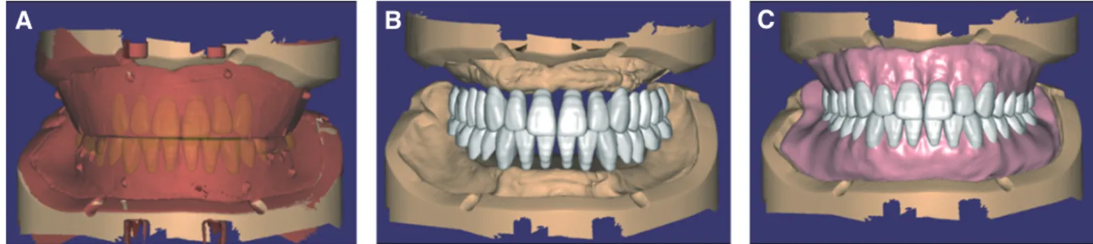 Fig. 9. Design of complete denture using Exocad program. (A) Anterior teeth setup using upper wax rim, (B) Whole denture teeth setup, (C) Artificial gum for- for-mation.