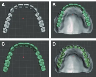Fig. 11. Design of accurate denture margin using Meshmixer program. (A) definitive cast STL file, (B) inverted cast STL file, (C) Upper denture base having ce- ce-ment gap, (D) Superimpose upper inverted cast and upper denture base STL file, (E) Connect ma