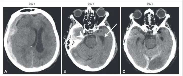 Fig. 1. Axial brain CT slices: (A and B) on admission and (C) 2 days later following subdural evacuation