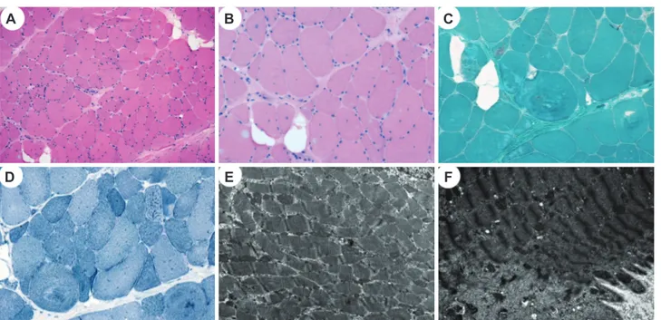 Fig. 1. Histopathological findings of vastus lateralis muscle biopsy. A and B: Hematoxylin and eosin staining revealed marked variations of the fi- fi-ber size and shape with frequent internalization of sarcolemmal nuclei and splitting; vacuolization of th