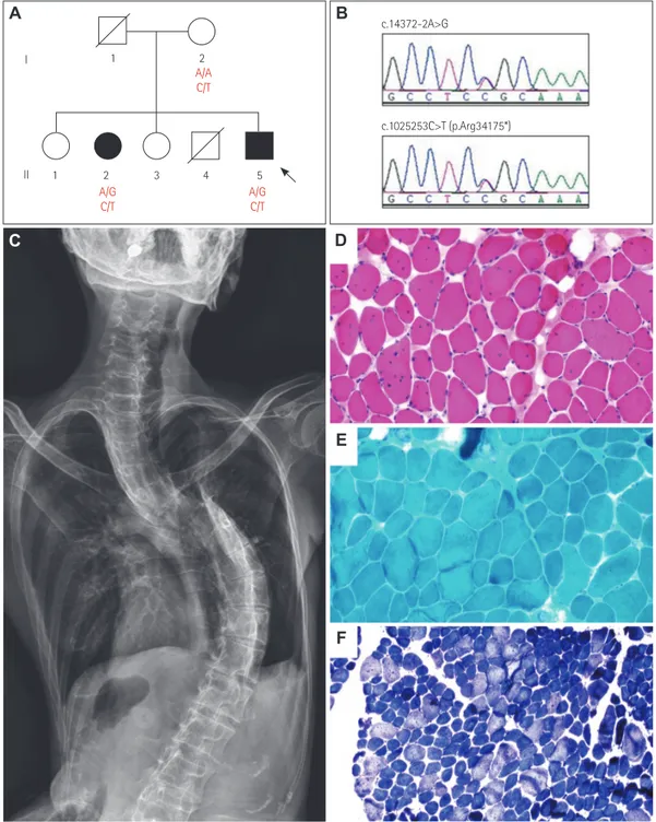 Fig. 1. Pedigree, sequencing chromatograms, whole-spine X-ray images, and pathology results
