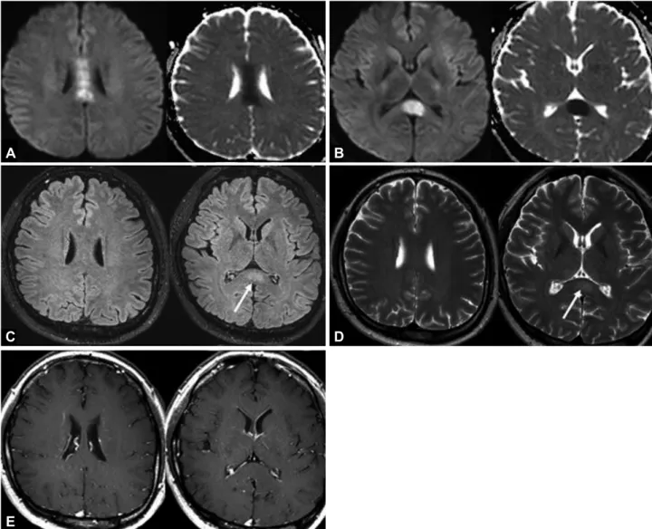 Fig. 1. Diffusion-weighted imaging revealed an ovoid-shaped lesion with restricted diffusion in the corpus callosum and splenium on the day of  admission (A and B)