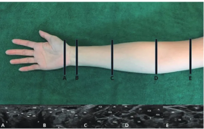 Fig. 2. Ultrasonography cross-sectional area measurements at five lo- lo-cations of the median nerve