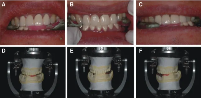Fig. 4. Condylar guidance angle adjustment by check-bite method. (A, D) Right lateral movement, (B, E) Protrusive movement, (C, F) Left lateral movement.