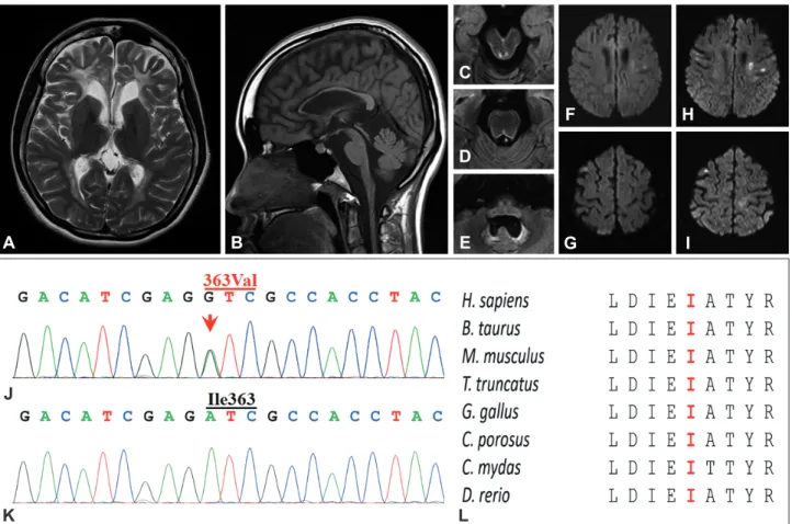 Fig. 1. MRI findings and mutational analysis of the patient. A: T2-weighted axial MRI image showing high-signal-intensity lesions in the bilateral  periventricular WM with frontal predominance