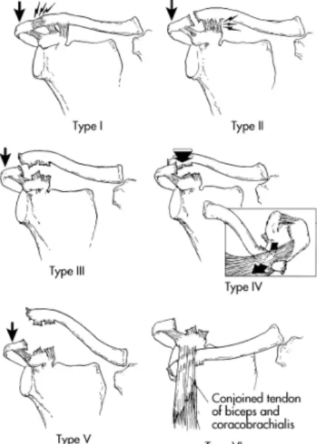 Fig. 2. Rockwood classification of AC  dislocation 각-승모근막이 쇄골에서 박리되면서 쇄골이 상부로 전위된다.  오구 돌기와 쇄골 간의 간격이 건측에 비해  25~100%  정도  증가된  경우이다