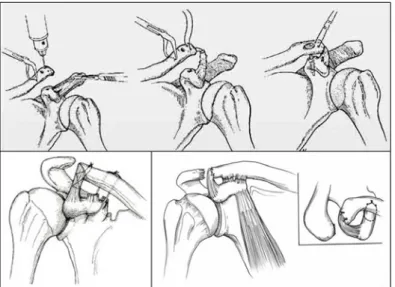 Fig. 3. Weaver-Dunn Reconstruction Technique