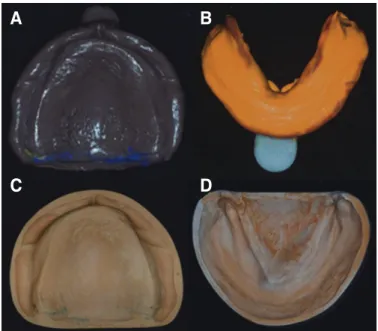 Fig. 4. Jaw relation record and mounting. (A) Vertical dimension, (B) Hori- Hori-zontal relation, (C) Mounted cast