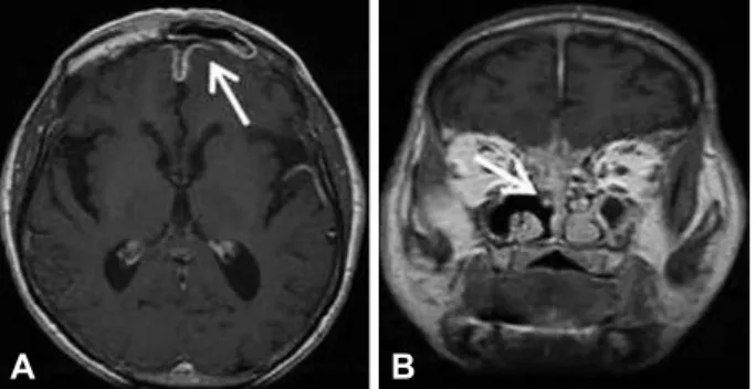 Fig. 1. Brain MRI. A: An axial, T1-weighted cranial MRI image obtained  after administering intravenous contrast medium, the arrow point the  epidural enhancement on the frontal lobe