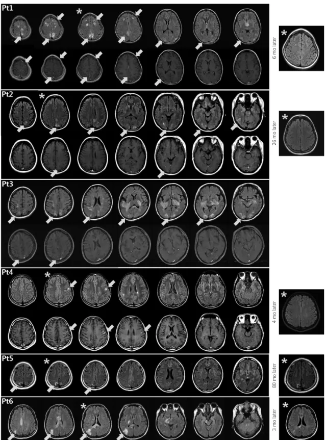 Fig. 1. Brain abnormalities in neuromyelitis optica spectrum disorder (NMOSD) patients on fluid-attenuated inversion recovery (FLAIR) (upper  rows) and T1-weighted enhanced (lower rows) magnetic resonance imaging (MRI) scans obtained at the time of cortica