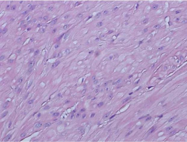 Fig. 3.  Case 2. Multifocal necrosis in the mass, note bundles of neoplastic spindle cells associated with vascular channels