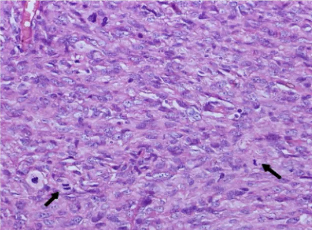 Fig. 4.  Case 3. Nuclear and cellular pleomorphism with high mitotic figures (arrows)