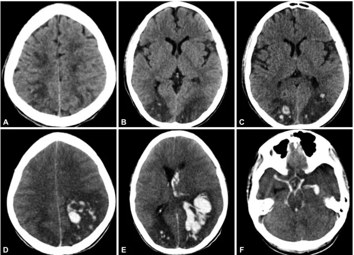 Fig. 1. Brain CT in the first presentation. A: Subcortical edema extends to the parietal and frontal region