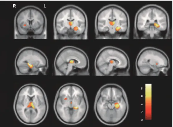 Fig. 1. Statistical brain map revealing gray matter volume (GMV) reductions in the brains of patients with left mesial temporal lobe epilepsy (LM- (LM-TLE) compared with controls
