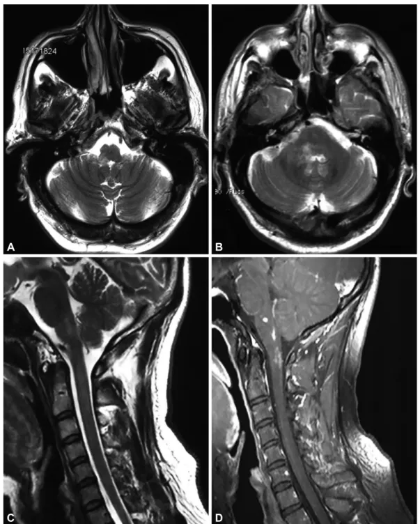 Fig. 1. Cranial magnetic resonance imaging of Case 1 (A and B) and Case 2 (C and D). A and B: Axial T2-weighted images showing irregular patchy  hyperintense areas predominantly in the right lateral medullary and pons, and also in the cerebellar pedunculus
