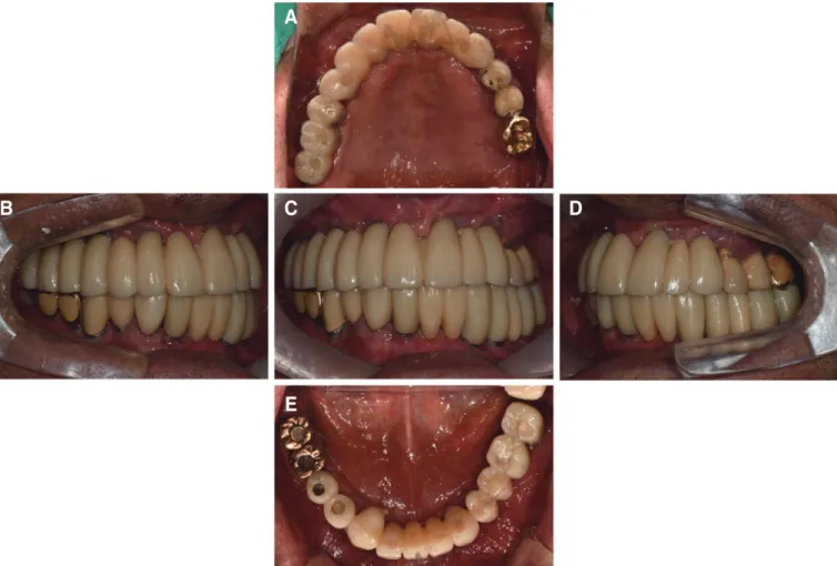Fig. 11. Definitive restorations. (A) Maxillary occlusal view, (B) Right lateral view, (C) Frontal view, (D) Left lateral view, (E) Mandibular occlusal view.