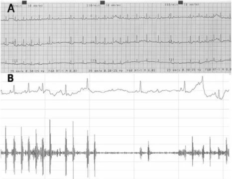 Fig. 1.  The electrocardiogram (A) and phonocardiogram (B) of this case. The electrocardiogram showed a second degree atrioventricular heart block (atrial rate: 125 bpm, ventricular rate 120 bpm) with QT prolongation (QTc = 269 × 10.8 msec).