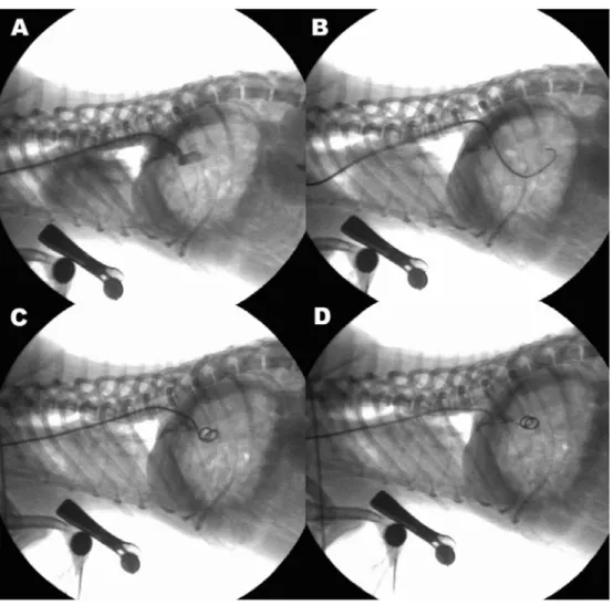 Fig. 4.  Transvenous coil embolization of this case. (A) A 5F angiocatheter was inserted through jugular vein to visualize the shunted area