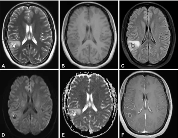 Fig. 1. A: T2 weighted images of the patient. It showed mild hyperintensity in right temporal and parietal lobe