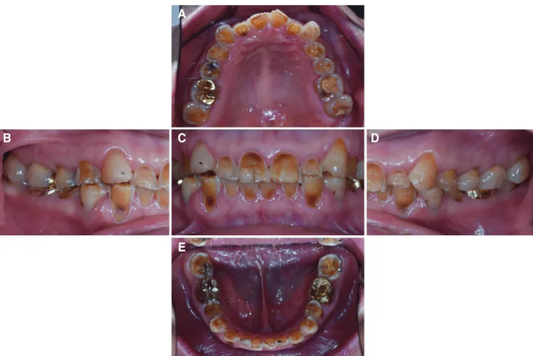 Fig. 1. Intraoral photograph before treatment. (A) Upper, (B) Right, (C) Frontal, (D) Left, (E) Lower.