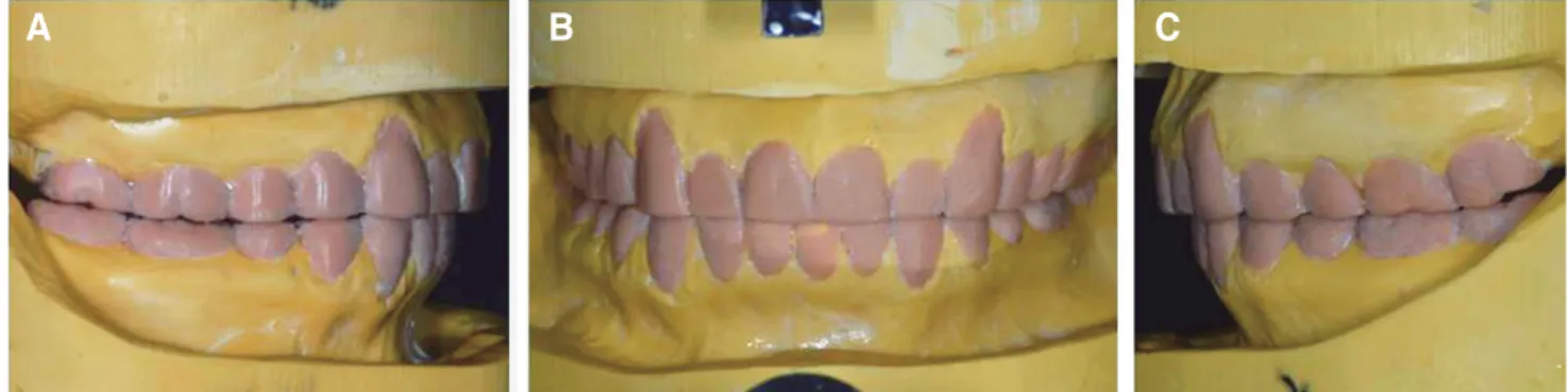 Fig. 5. Diagnostic wax up. (A) Right, (B) Frontal, (C) Left.