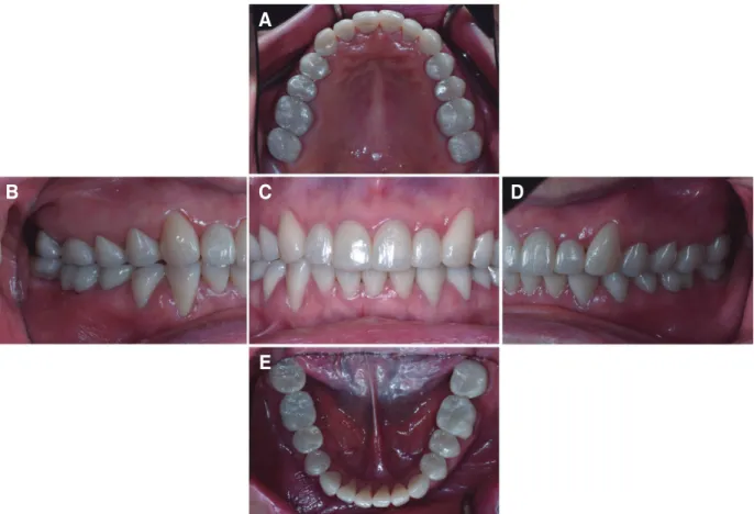 Fig. 9. Intraoral photographs of definitive prostheses. (A) Upper, (B) Right, (C) Frontal, (D) Left, (E) Lower.