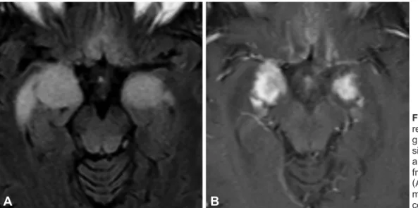 Fig. 1. Brain fluid attenuated inversion  recovery imaging performed before  sur-gery showing a diffuse hyperintense  signal within the medial temporal lobes  and extending into the basal ganglia,  frontal basal lobes, and leptomeninges  (A)