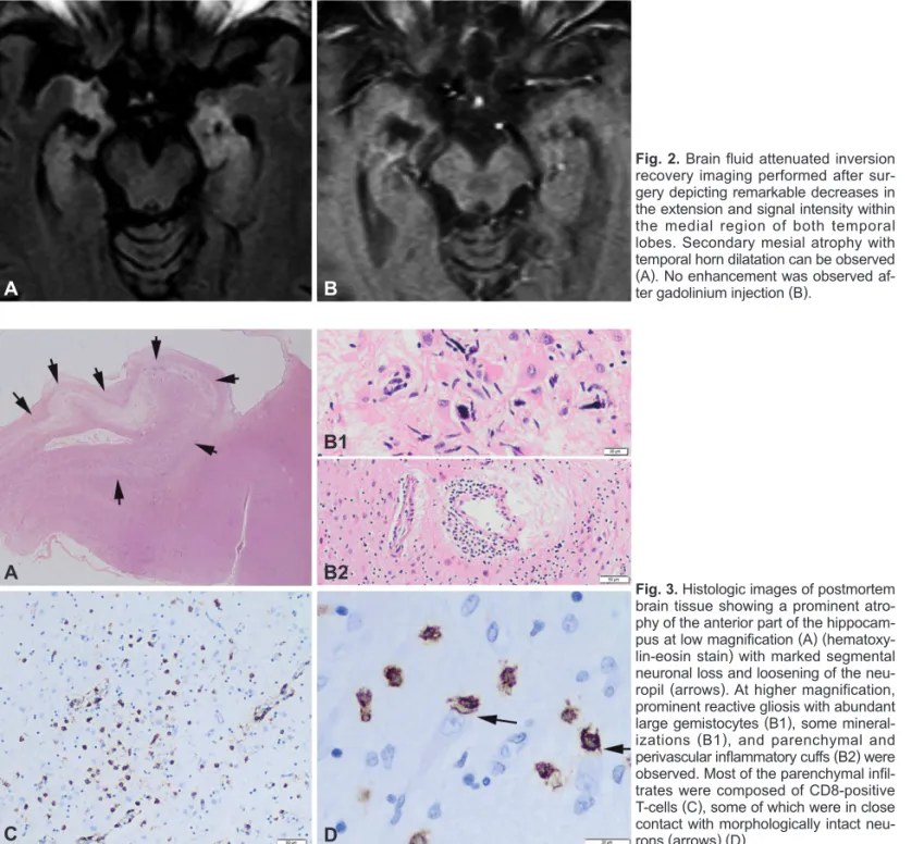 Fig. 3. Histologic images of postmortem  brain tissue showing a prominent  atro-phy of the anterior part of the  hippocam-pus at low magnification (A)  (hematoxy-lin-eosin stain) with marked segmental  neuronal loss and loosening of the  neu-ropil (arrows)