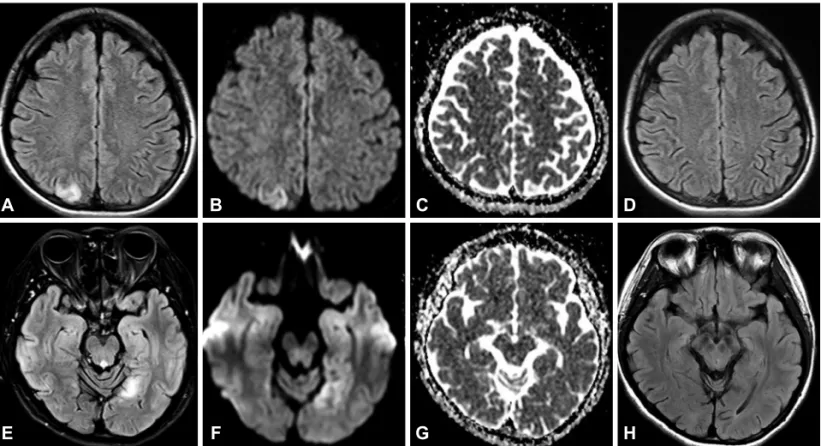 Fig. 1. A, B, and C: Diffusion-weighted imaging (DWI) and fluid-attenuated inversion recovery (FLAIR) MRI scans during the first episode  showing a high signal intensity in the right parietal lobe