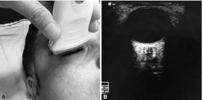 Fig. 1. A: Trans-orbital technique to obtain axial image of optic nerve. The subject in supine position, probe is placed on temporal and superior por- por-tion of the closed eye using large pad of gel with the subject’s gaze at midline