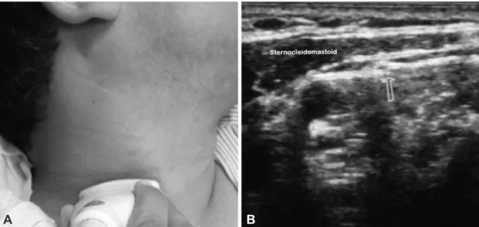Fig. 4. A: Spinal accessory nerve scanning technique. The subject is in lateral decubitus position with head rotated to the side opposite the  scanned side