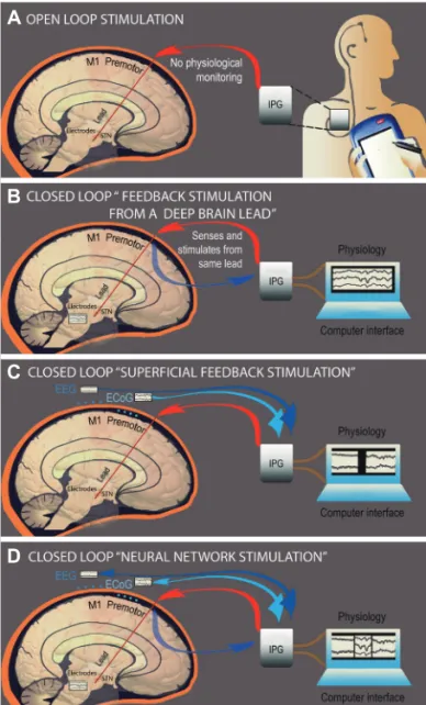 Fig. 2. Summary of the proposed approaches for DBS in Tourette  syndrome. A: The conventional stimulation in an open loop fashion  currently used widely in movement disorders, where energy is  con-tinuously delivered to a target, with parameters set by a c