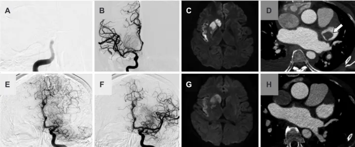 Fig. 1. Digital subtraction angiography (DSA), brain MRI, and coronary computed tomography (CT) of the patient