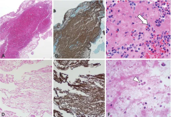 Fig. 2. Hematoxylin and eosin staining (original magnification ×40). (A) The extracted thrombus from the index stroke exhibited a large number of  red blood cells (RBCs), whereas (D) the clot extracted from the second stroke appeared to have fewer RBCs and