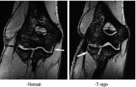 Fig. 3. Normal MCL on MRA vs. T-sign suggesting the partial tear of the medial collateral ligament (2)